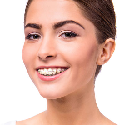 Clarity ceramic braces are available at Quest Johnson Orthodontics