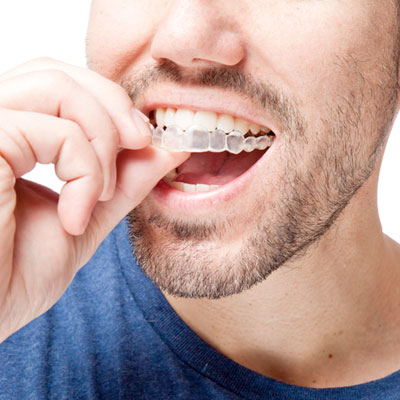 Invisalign clear braces for teens and adults in Indiana