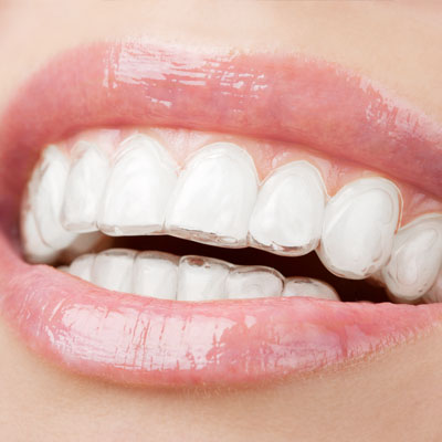 Why choose Invisalign clear braces for teens and adults